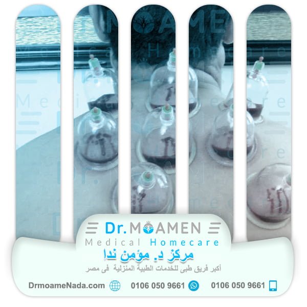 What is Hijama - Dr. Moamen Nada Center